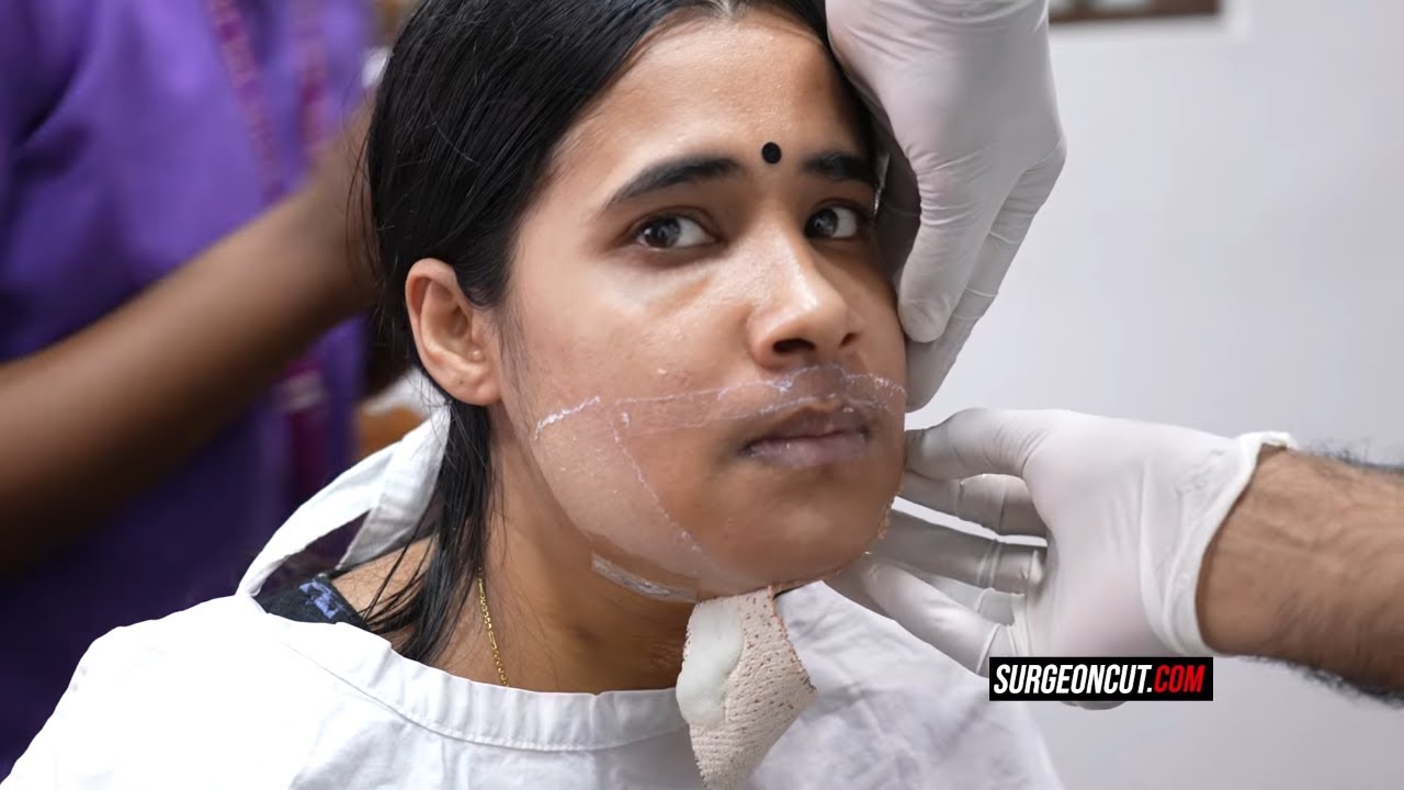 Women Genioplasty Surgery Results before and after | Full Surgery
