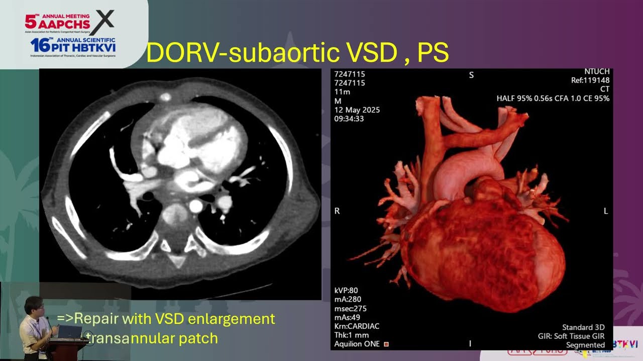 DORV-PS : Biventricular Repair Strategies - Shu Chien Huang