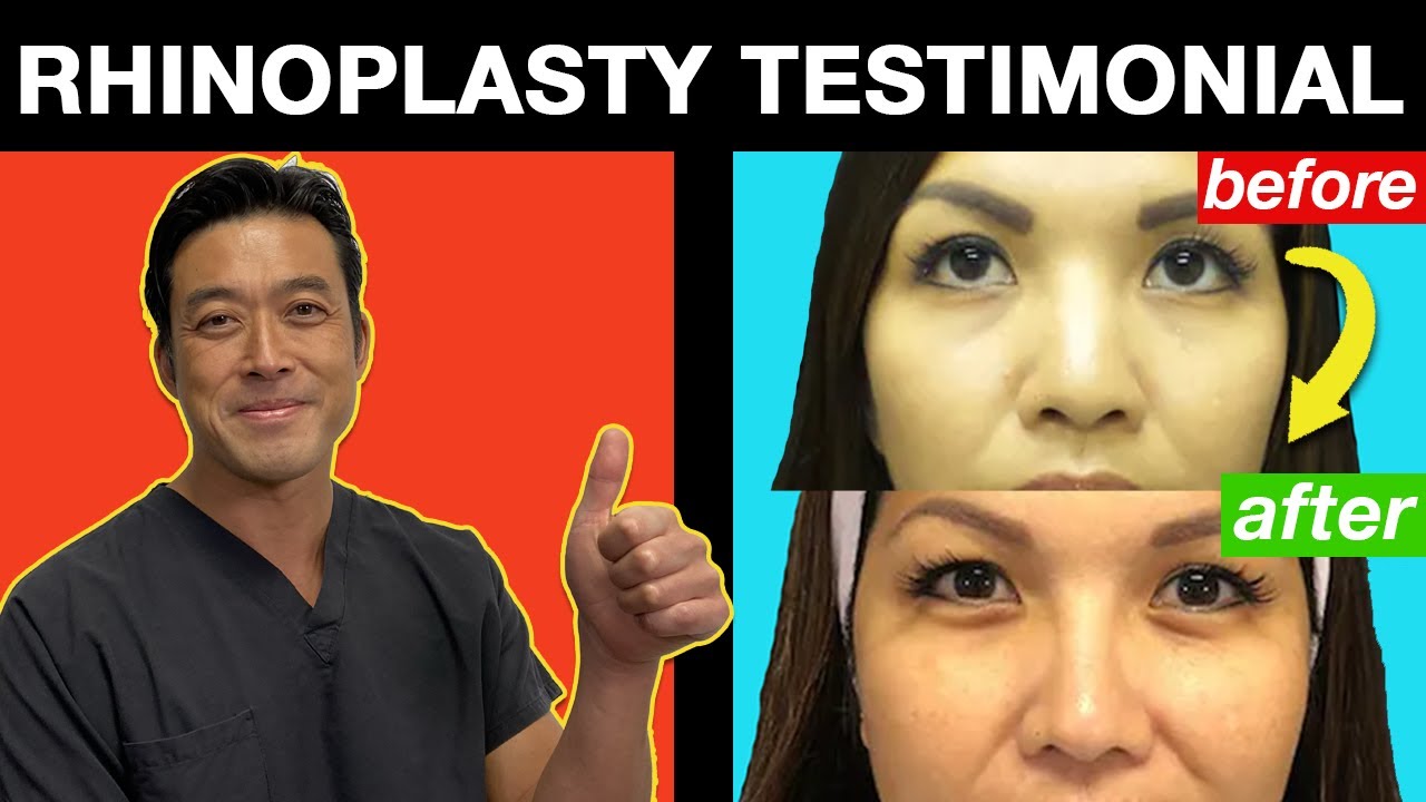 Marla's Rhinoplasty Testimonial with Dr. Shim Ching
