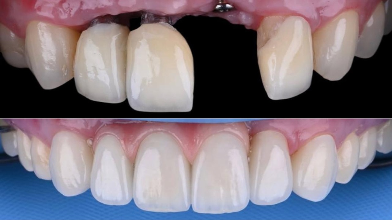 CERAMICA  SOLUCION DE CASOS COMPLEJOS