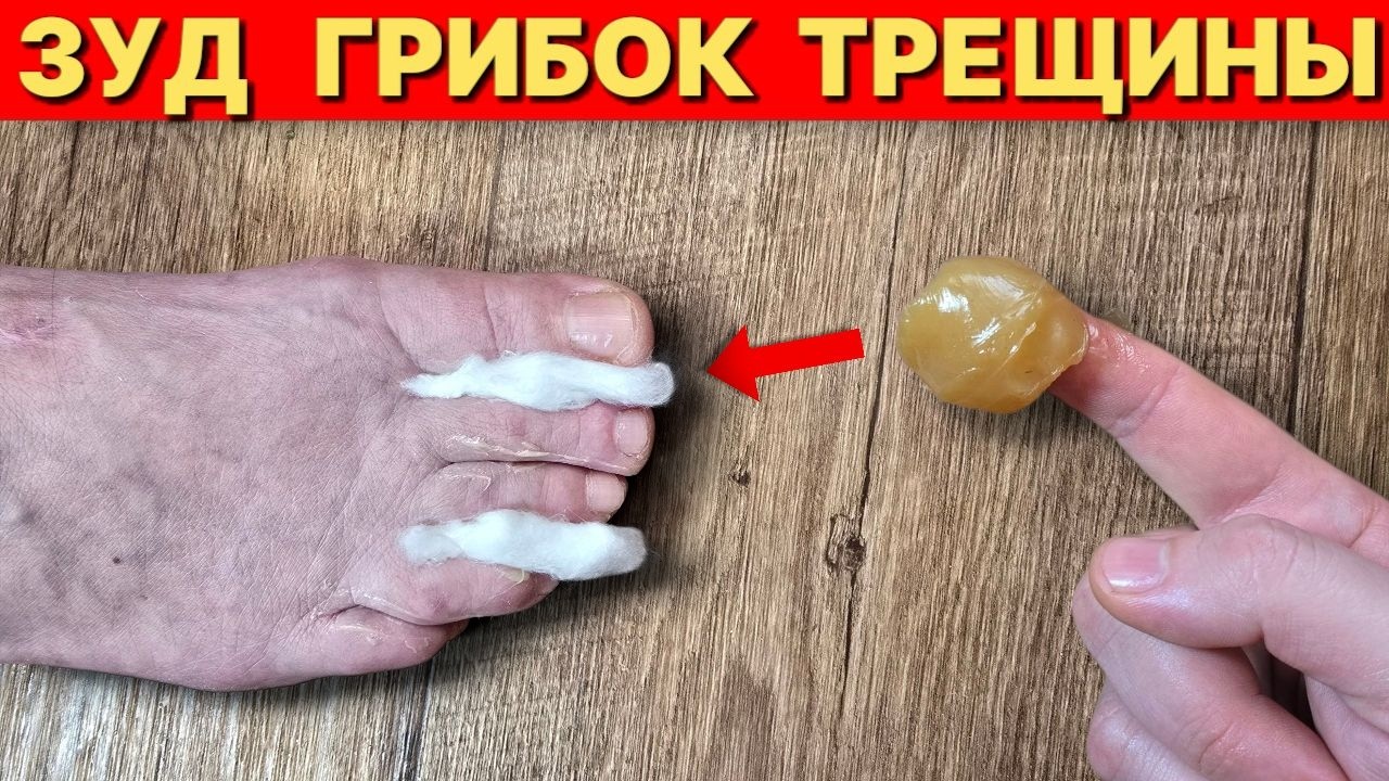 Как убрать зуд между пальцев грибок и трещины на ногах за 1 день