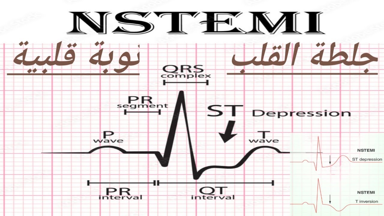 جلطة القلب.الأزمة القلبية.NON ST SEGMENT ELEVATION.NSTEMI  NON ST ELEVATION MYOCARDIAL INFARCTION