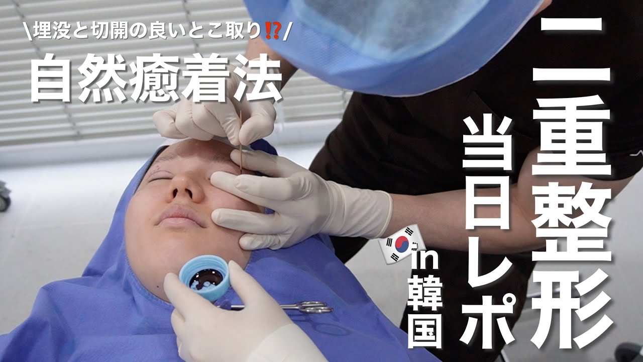 【韓国二重整形】【自然癒着法】⚠️NO案件❌韓国で初！３回目の二重手術と目つき矯正してきた！