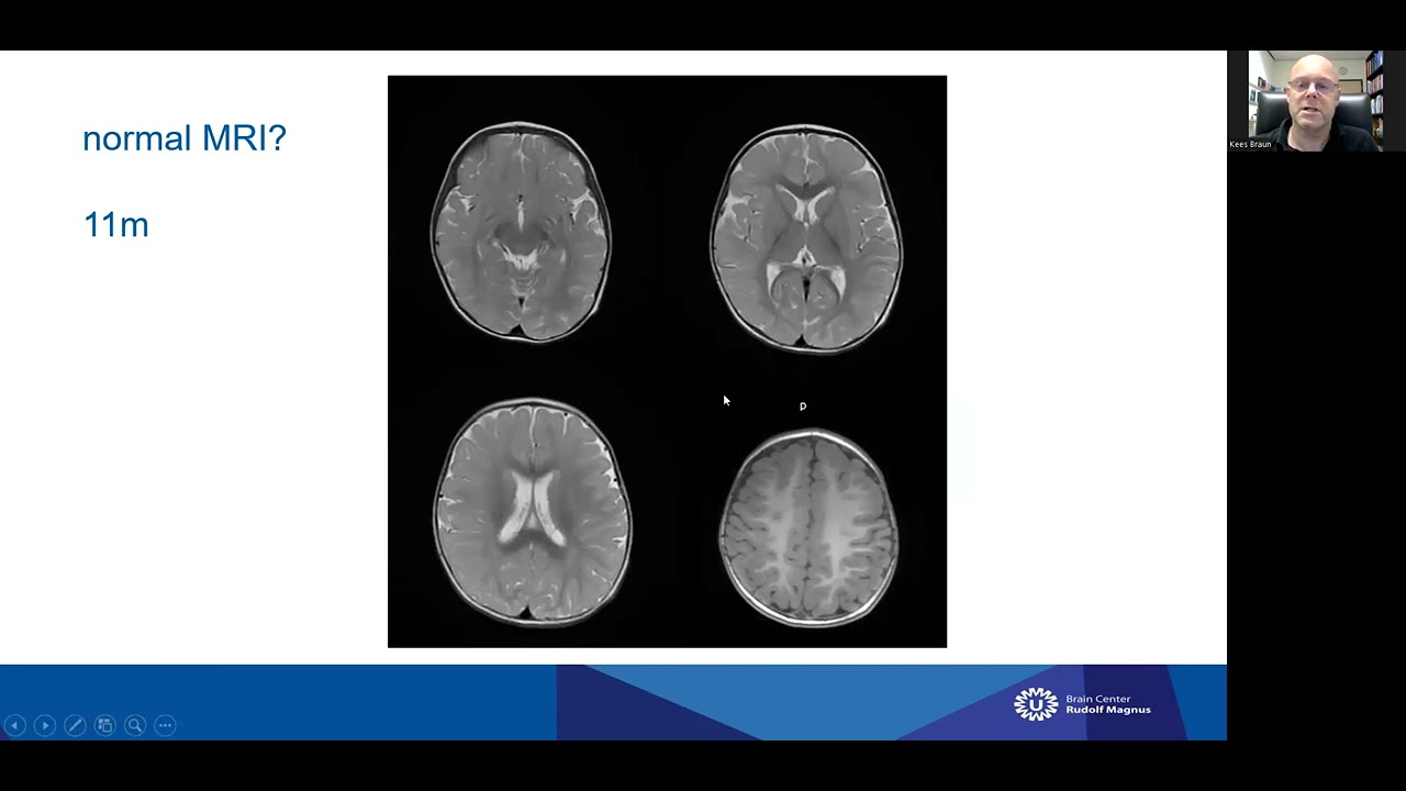 Neuroimaging in Epilepsy: Kees Braun, MD (the Netherlands)