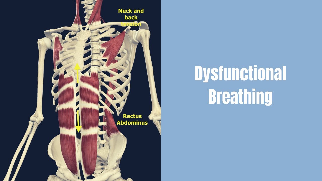 6- Pack Abs: Their Role in Dysfunctional Breathing and Chronic Pain