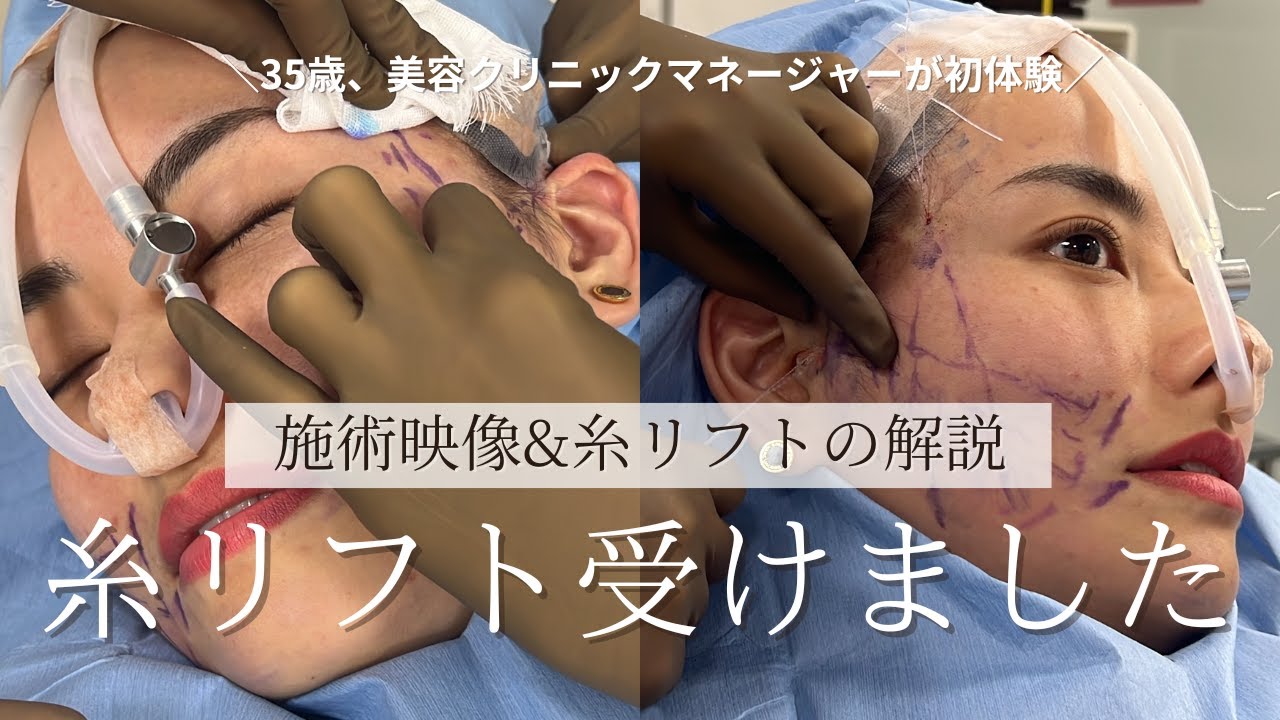 【糸リフト】糸リフトの効果？ダウンタイム？痛み？どこでやる？　衝撃映像と共に全てを解説致します！【衝撃映像】