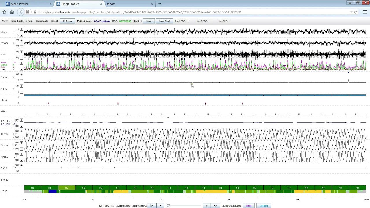 Assessment of Sleep and Sleep Disordered Breathing with PSG2