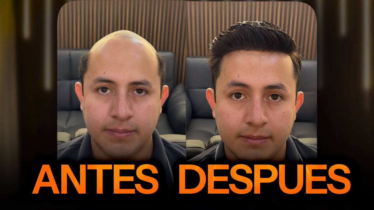 ¿Alopecia hereditaria? Así fue como lo resolví