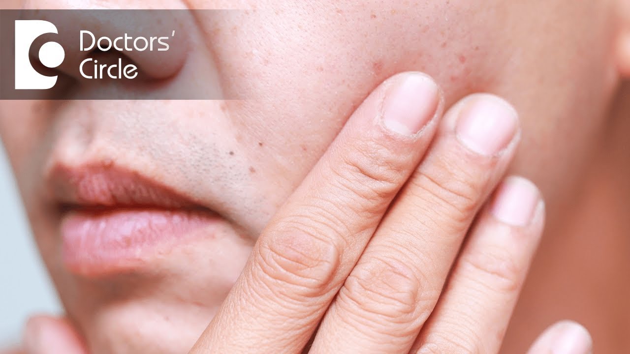 What causes red dots on face and its management? - Dr. Nischal K