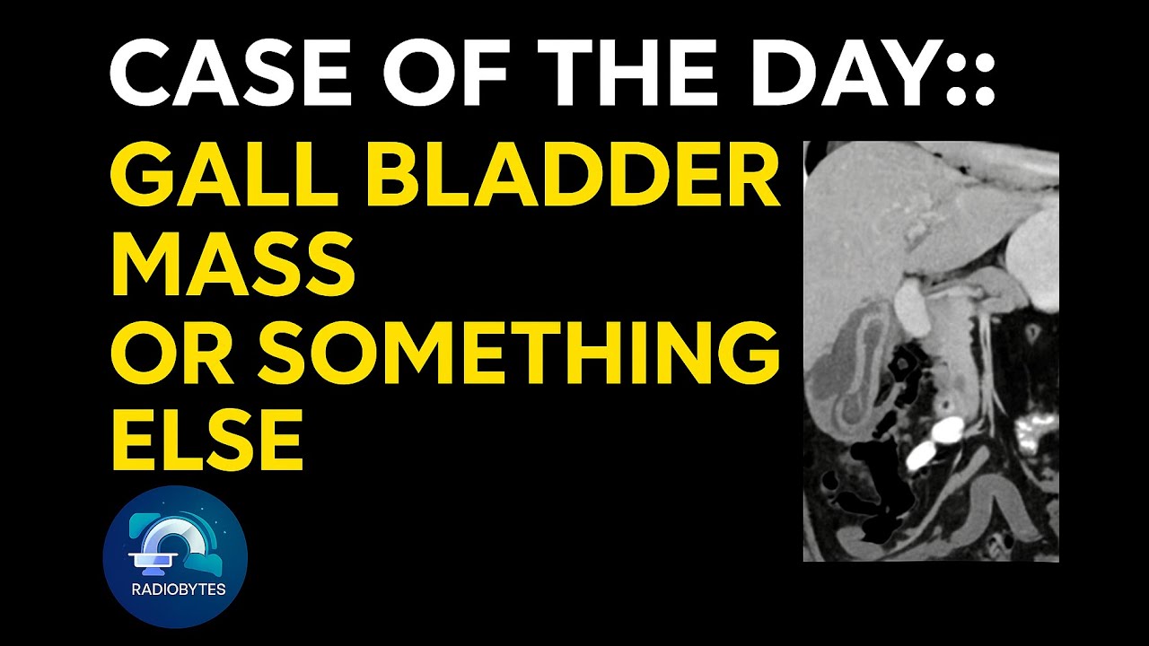Case of the Day:: Gall Bladder-Mass or Something Else