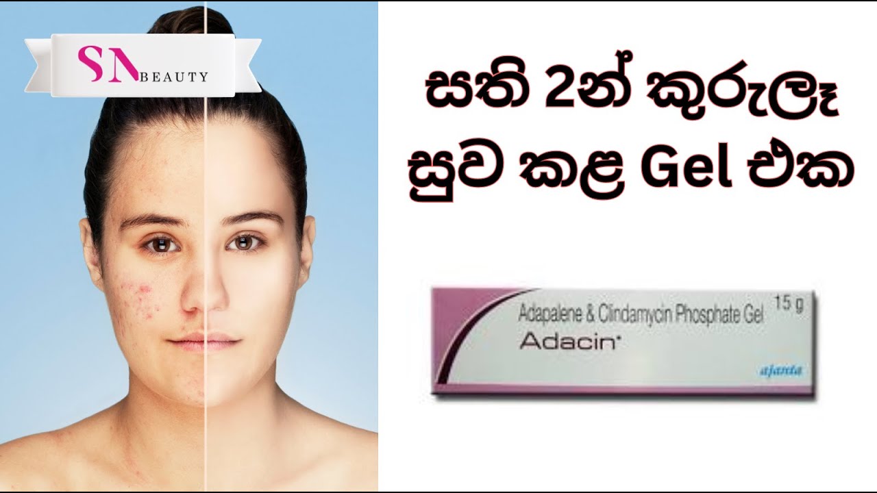 සති 2න් කුරුලෑ සුව කළ ක්‍රීම් එක | Adicin Cream - ගිහින් ගේන්න කලින් මේක බලන්න!