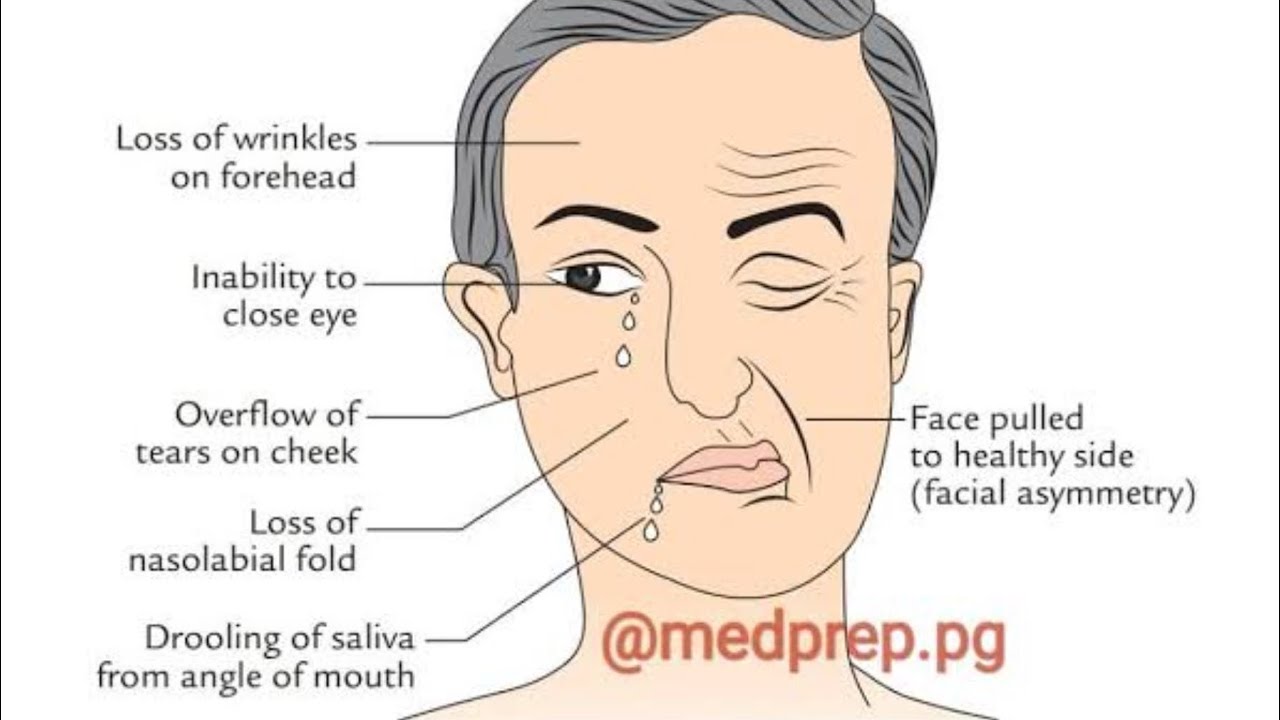Sudden Facial Paralysis? It Could Be Bell’s Palsy! | Complete ENT Revision