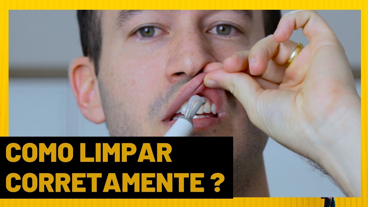 COMO LIMPAR PRÓTESE PROTOCOLO SOBRE IMPLANTE - DR. GUILHERME FELIX
