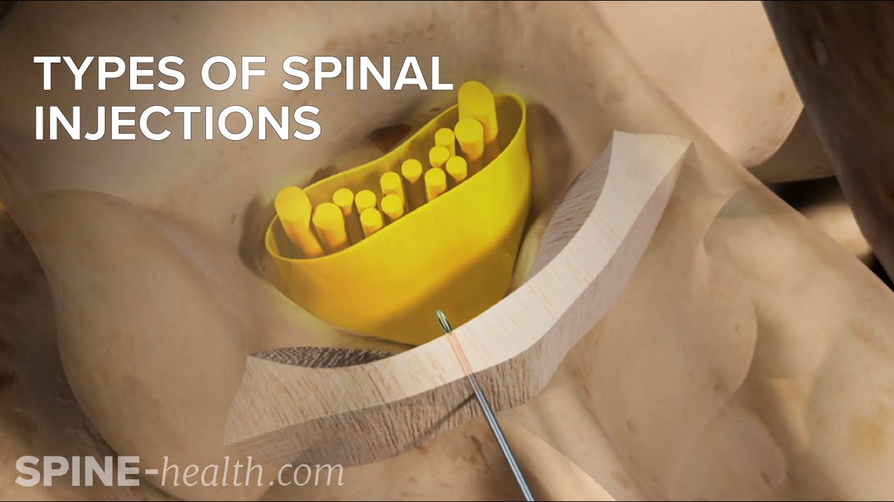 Types of Spinal Injections