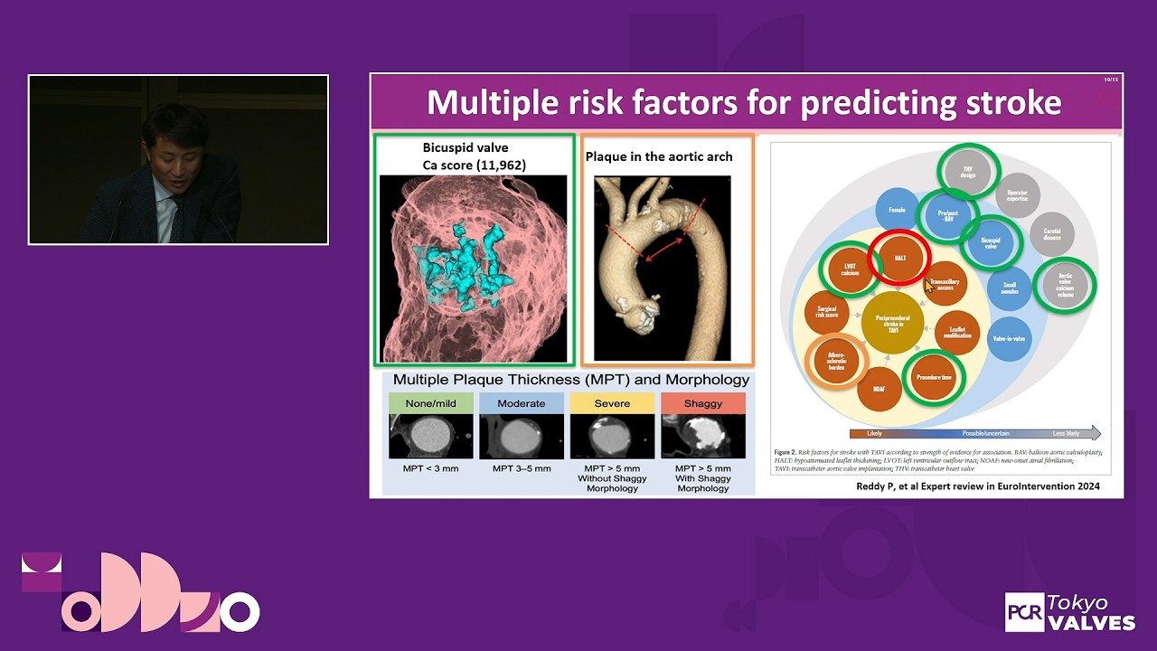Protect the brain for TAVI - True potential of SENTINEL Cerebral Protection System