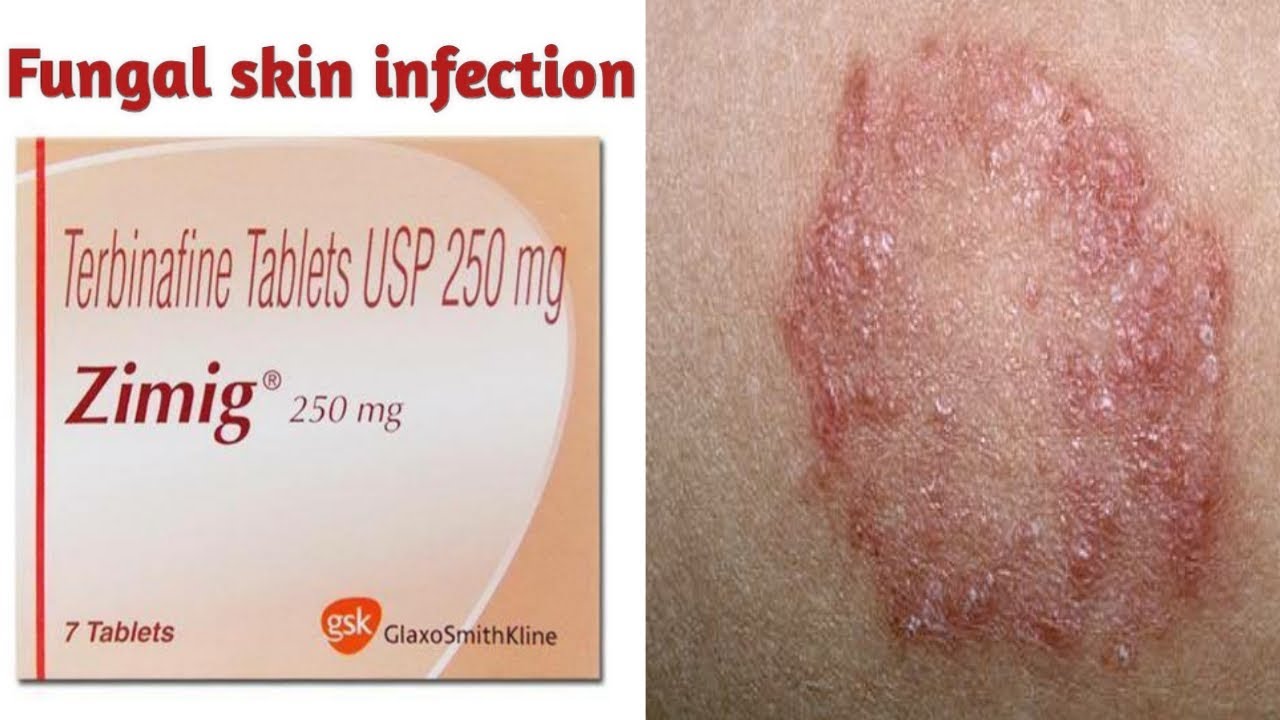 Zimig 250mg Tablet,Uses,एक ही बार में दाद खाद खुजली जड़ से ख़तम/fungal infection treatment/in hindi.