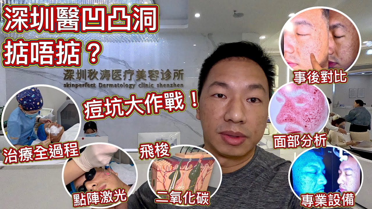 我的痘坑大作戰！深圳醫凹凸洞，暗瘡印掂唔掂？治療全過程，最佳治療方案，最頂級儀器，飛梭？二氧化碳？點陣激光？面部深入分析！#深圳好去處#痘坑痘印#祛痘#祛斑#抗衰老#秋濤#醫學美容