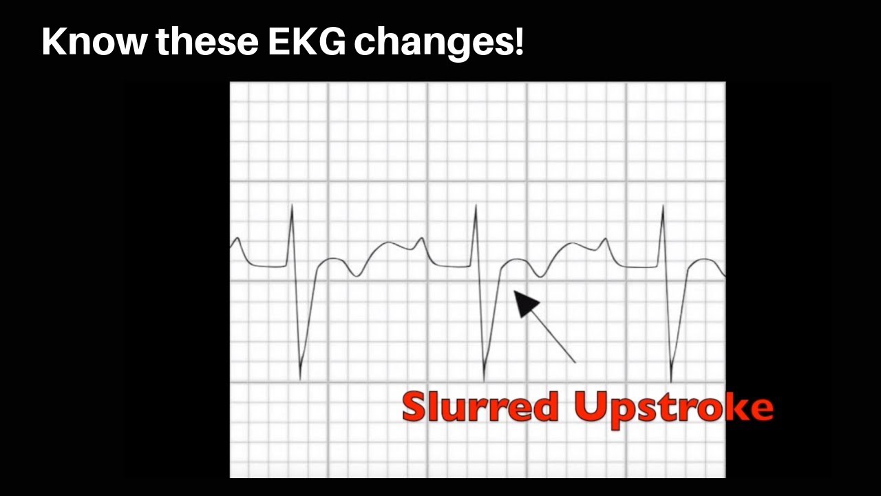 Cardiogenic Syncope