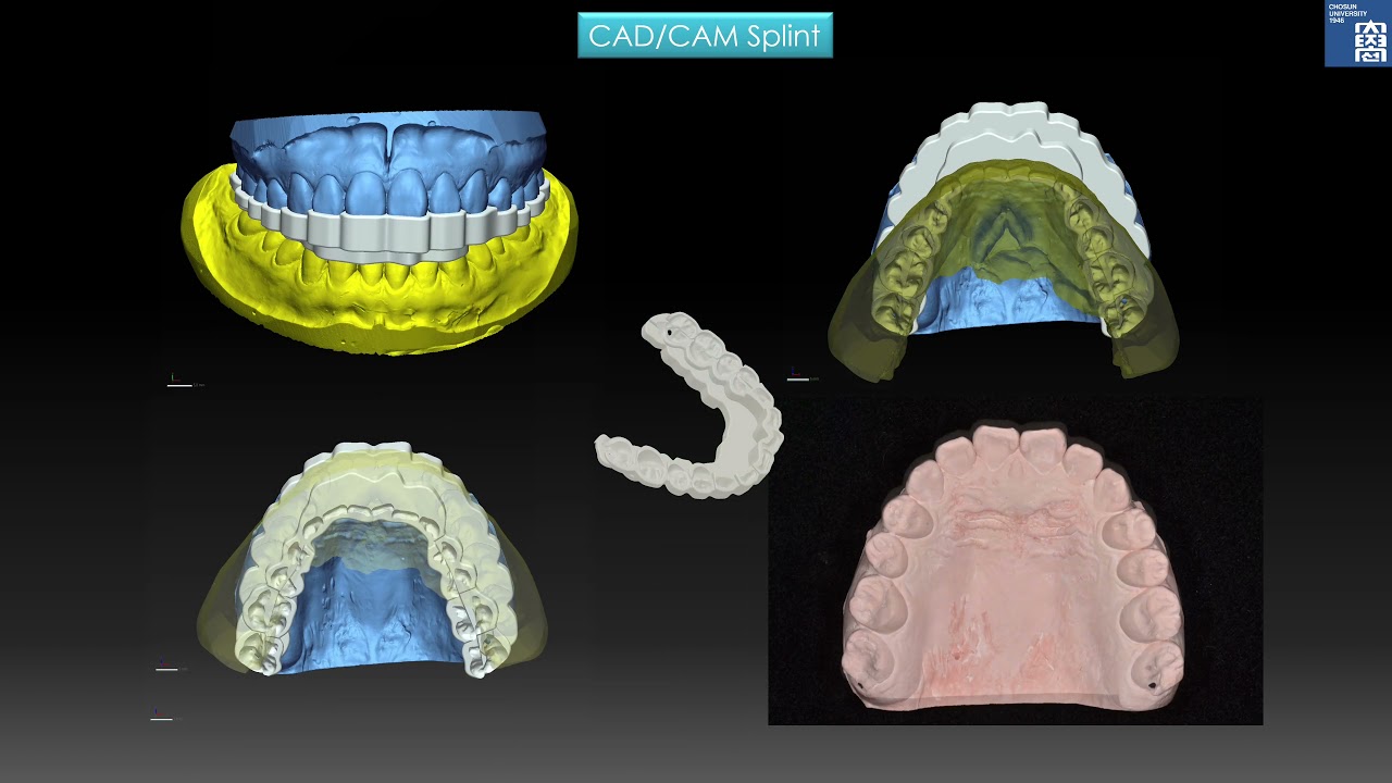 A surgery-first approach using single-jaw rotational mandibular setback in low-angle mandibular
