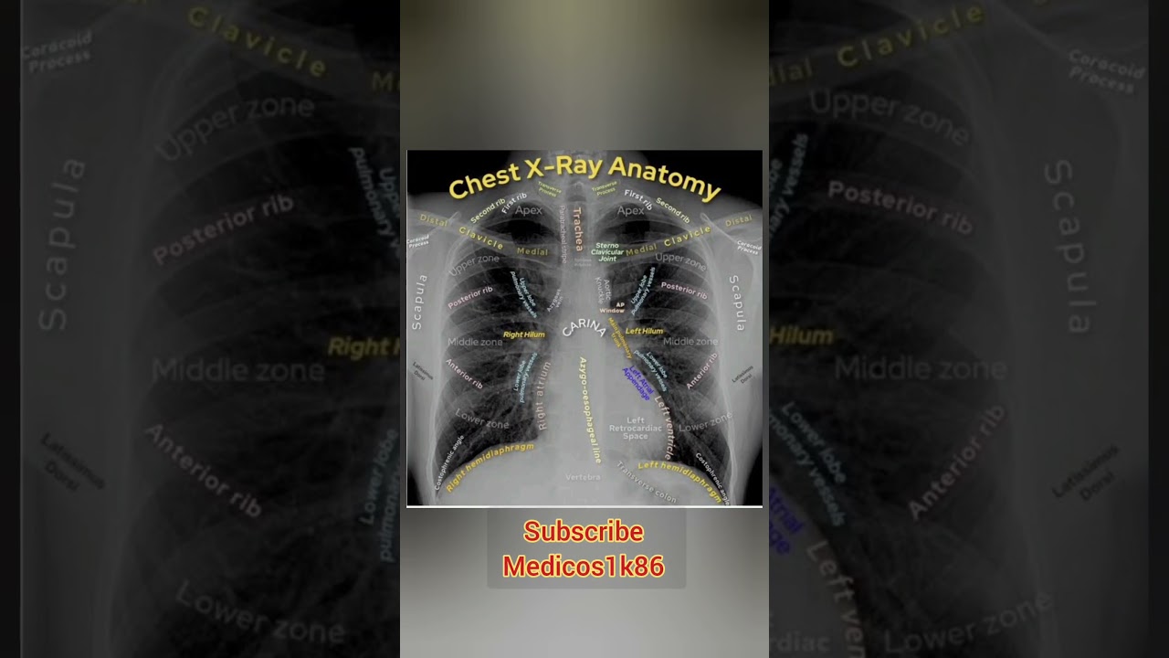 Chest X-ray कैसे पढ़ें | How to Read Chest X-ray | Normal Anatomy 