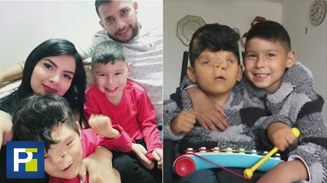 La historia de Thiago, un niño de 6 años que nació con una malformación en la cabeza