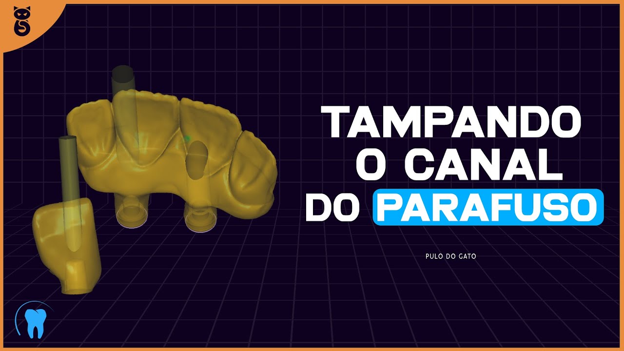 EXOCAD : Tampando o canal do parafuso