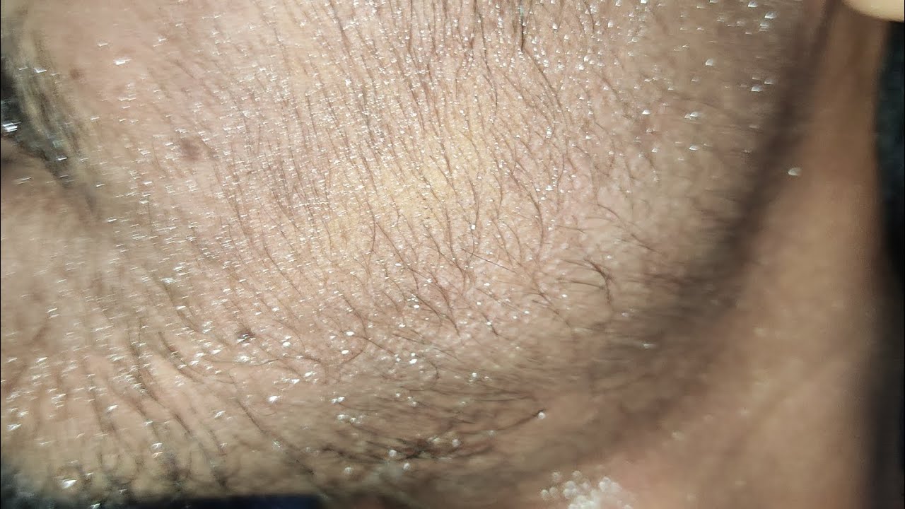 1 Month of using #manmatters #minoxidil beard growth journey #manmatters #skincare #minoxidil #mars 
