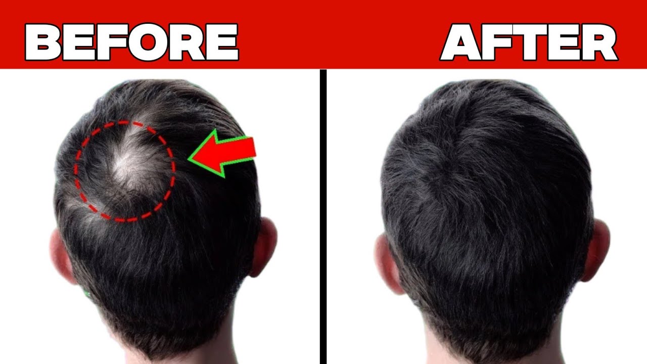 10 Natural Ways to Regrow Hair Faster | Before & After Results