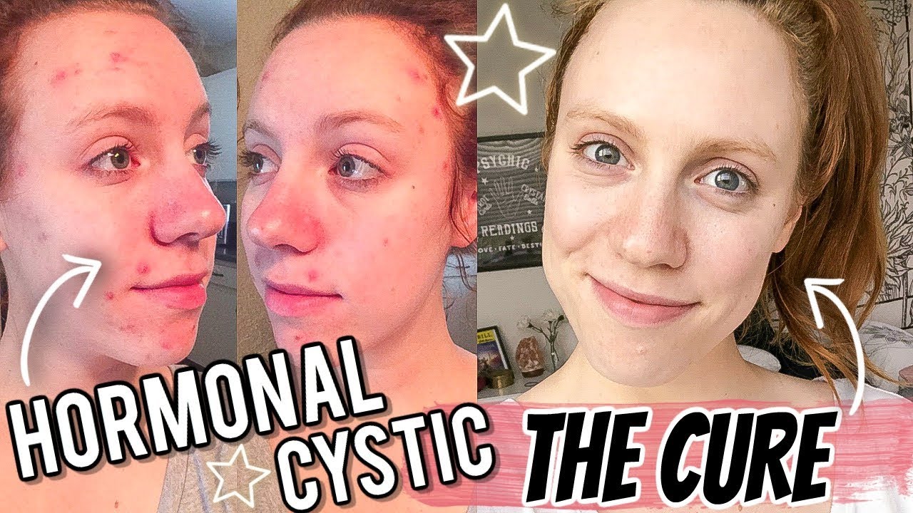 How I FINALLY Cured My Cystic Acne FOR GOOD ⭐️