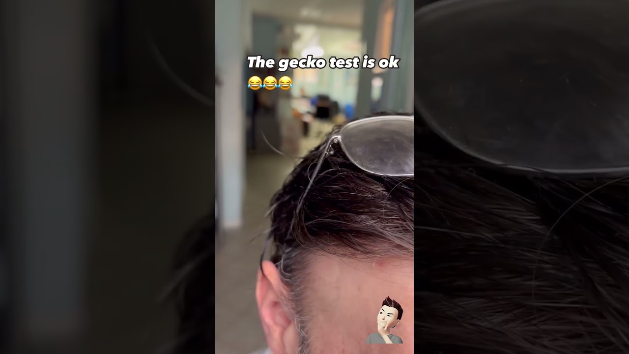 Alopecia: Con il gekco 3T Ionix l&rsquo;attaccatura frontale dei Capelli Intelligenti &egrave; invisibile