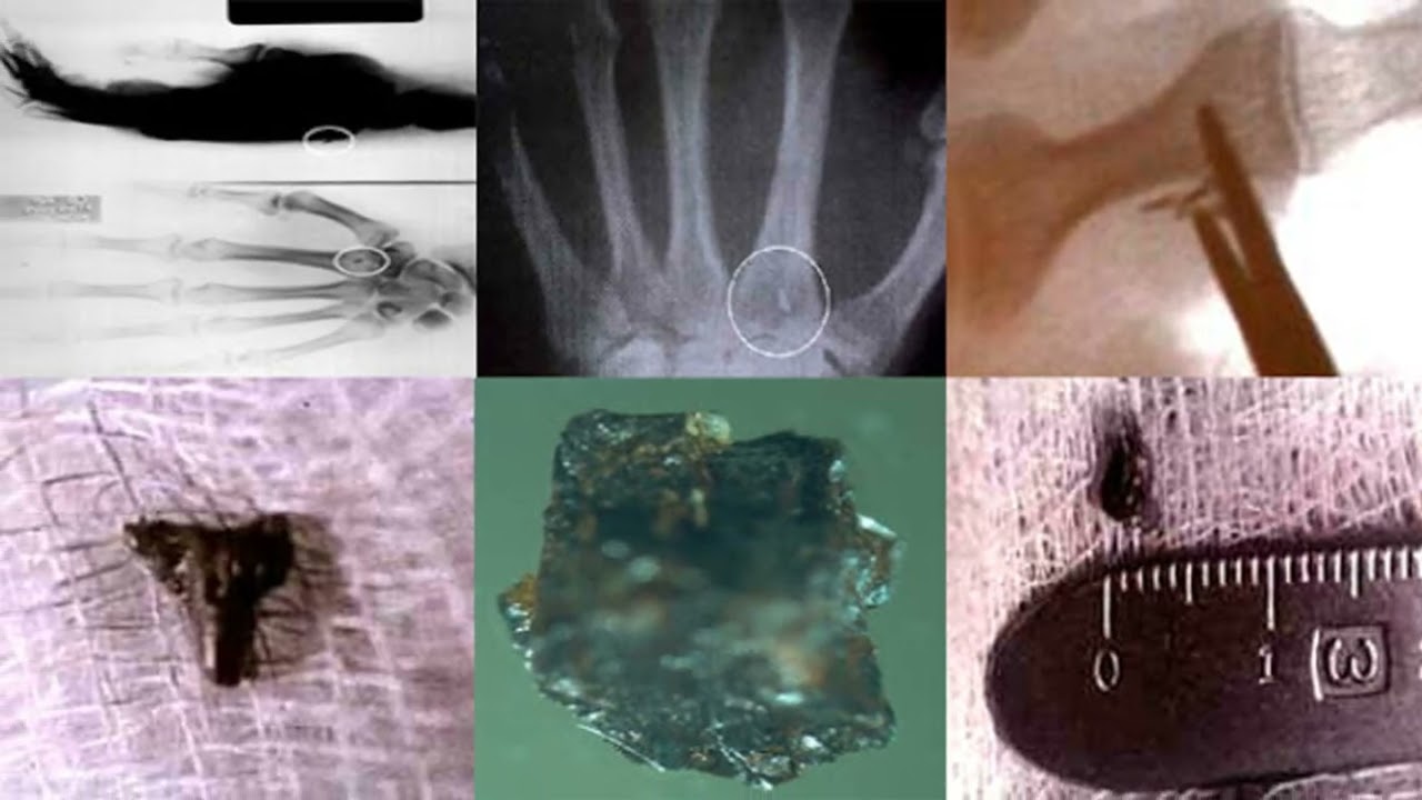 Unraveling the Mystery of Alien Implants: Dr. Roger Leir's Legacy