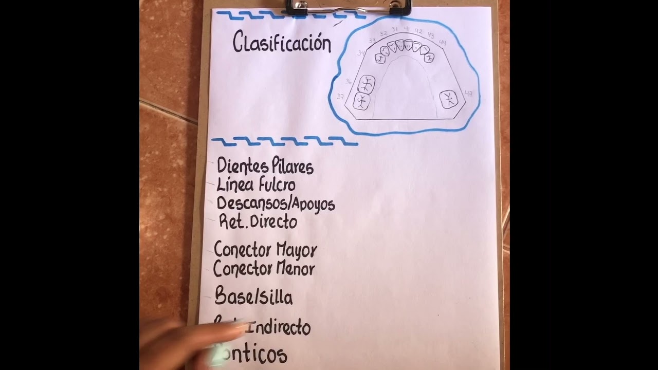 Diseño de prótesis PPR