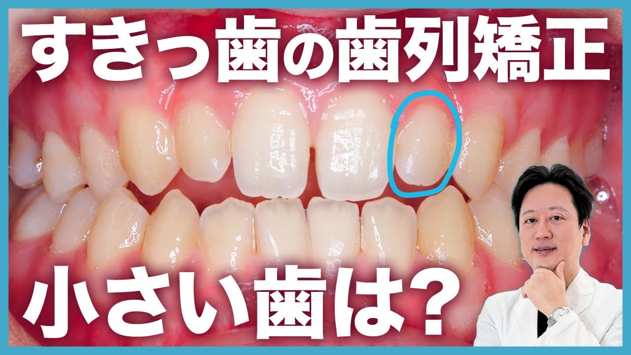 矮小歯がある矯正治療！すきっ歯オープンバイトと小さな歯を綺麗に！【審美歯科 歯列矯正 歯並び】