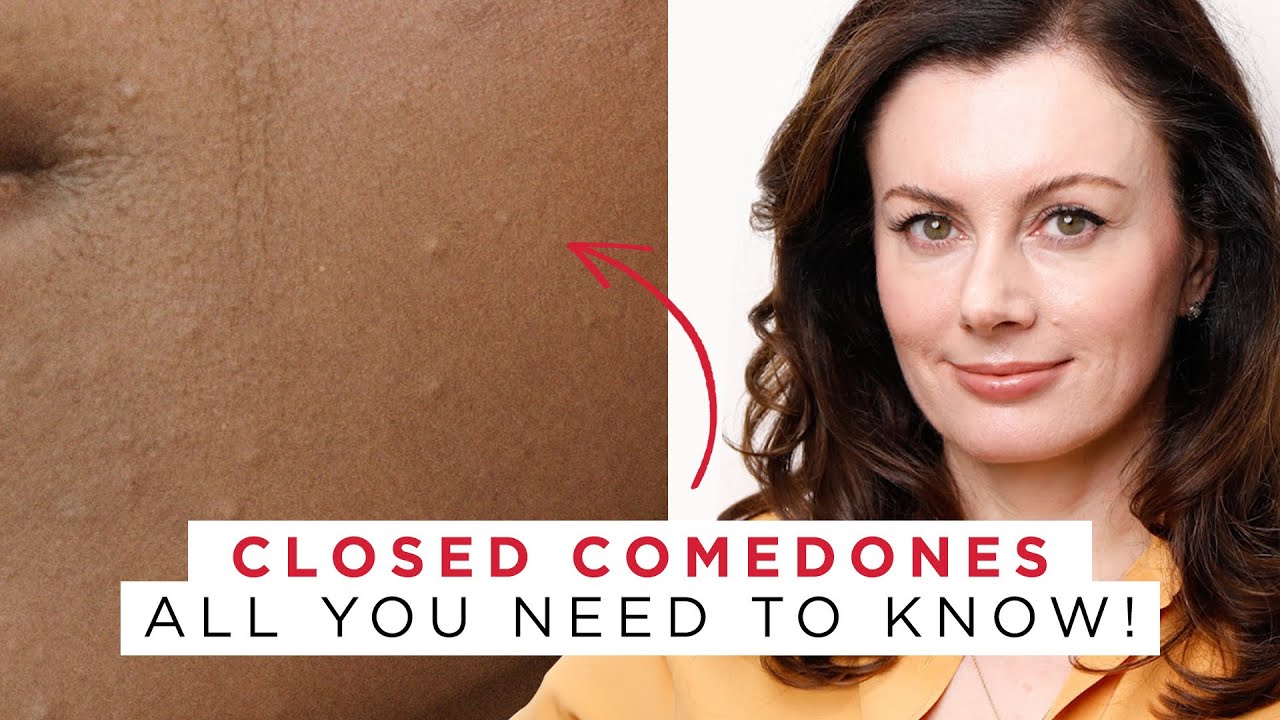 The Most-Asked Questions About Closed Comedones - Answered!  | Dr Sam Bunting