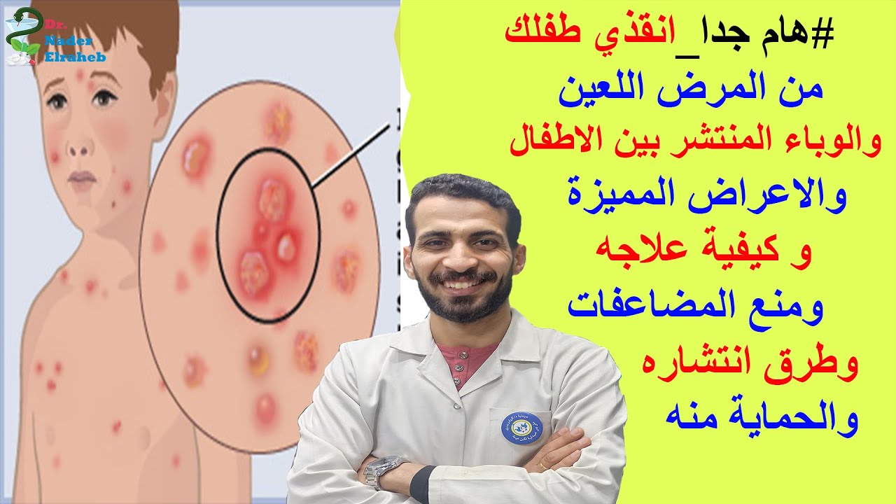 مرض الجديري المائي : اسبابه و اعراضه و روشتة علاج كاملة والادوية المحظورة علي الاطفال تناولها نهائيآ