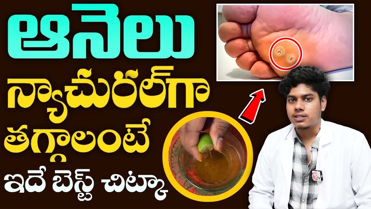 ఆనెలు జీవితంలో రాకుండా తగ్గించే సింపుల్ చిట్కా | How To Remove a Foot Corn or Callus | Dr. Hemanth