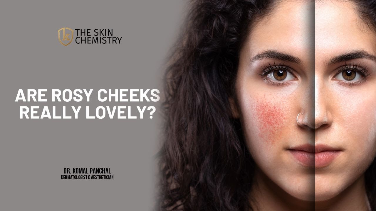 Are Rosy Cheeks really Lovely??