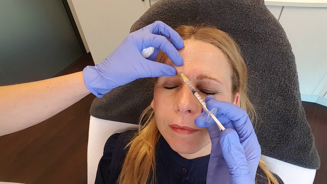 WEG MET JE FRONS MET BOTOX | BEAUTYVLOGGER SUSAN | VELTHUISKLINIEK