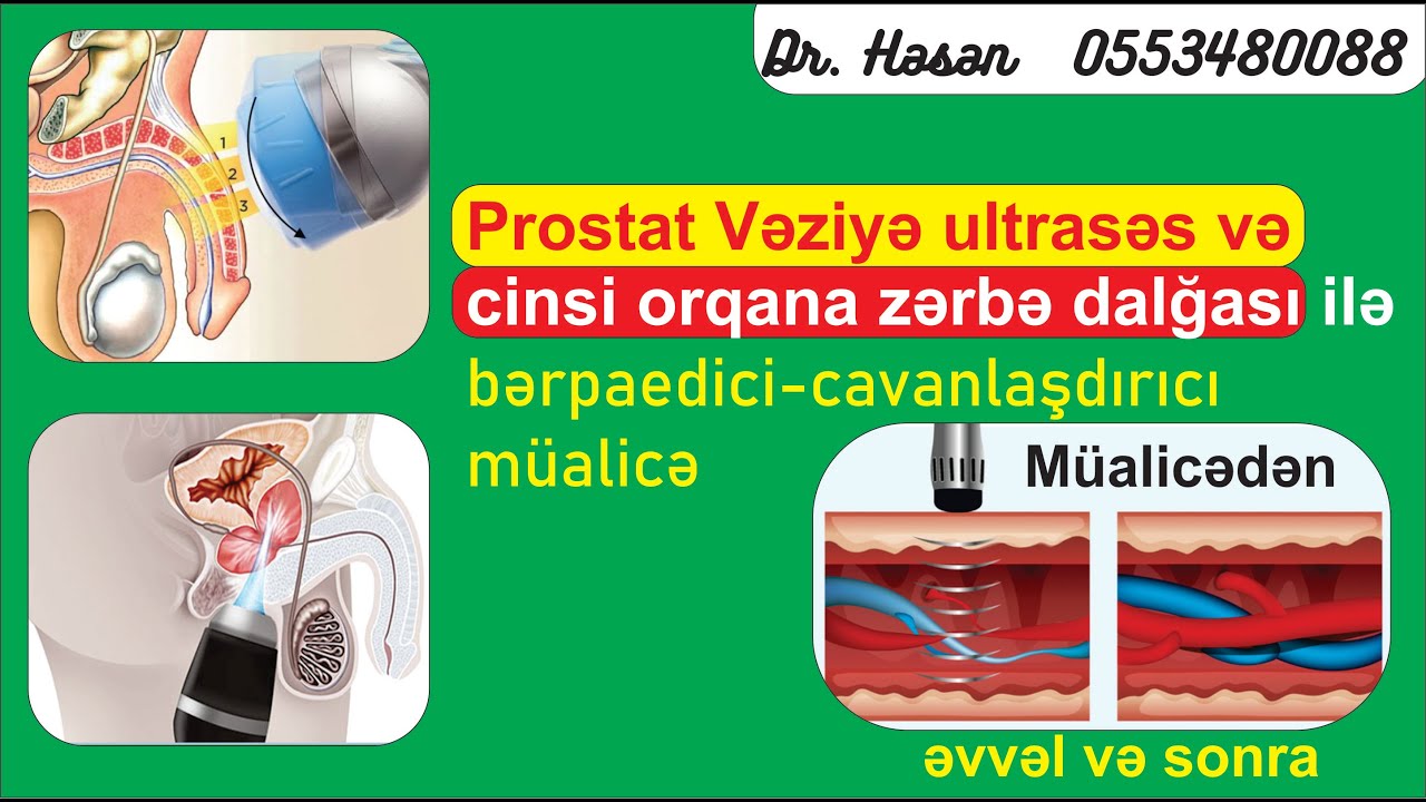 Dr. Həsən  055 348 00 88__Cinsi Zeiflik ve erken bosalmada mualice