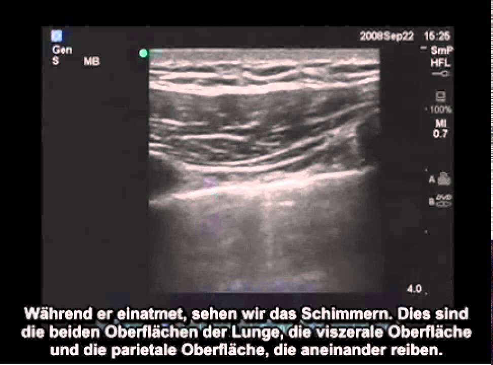 Anleitung: Pneumothorax-Analyse mit Ultraschall