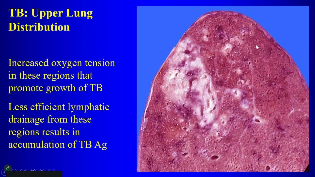 14a Interstitial Lung Disease P1 Upper Lung Disease
