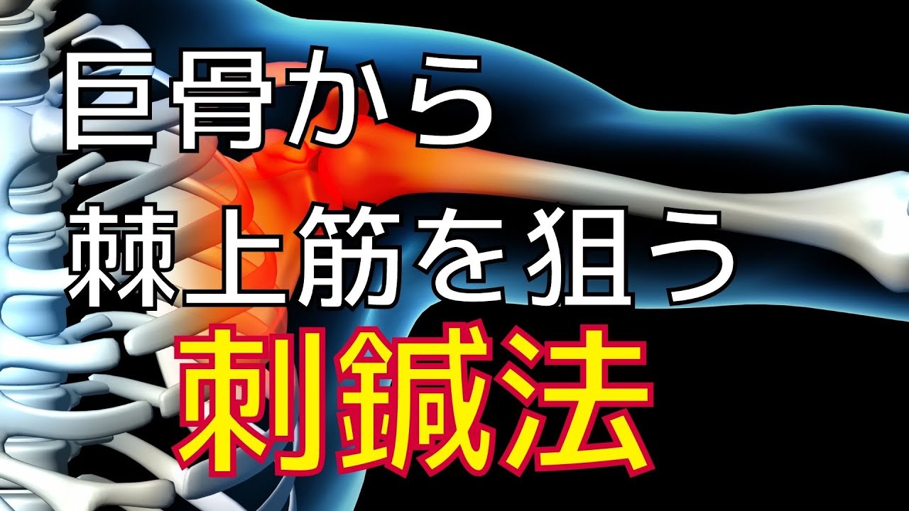 棘上筋の刺鍼法｜巨骨から肩峰下へ