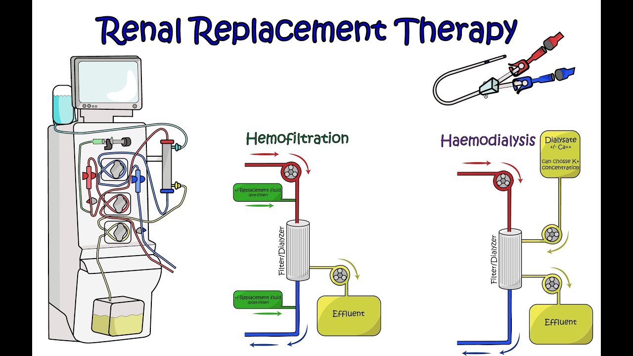Renal Replacement Therapy on the ICU (2023, rapid guide, overview)