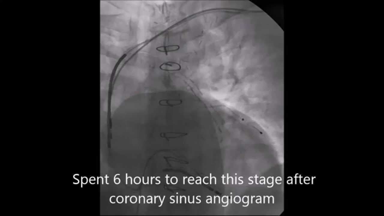 A Novel Technique for Placement of Left ventricular lead  in Cardiac Resynchronization Therapy