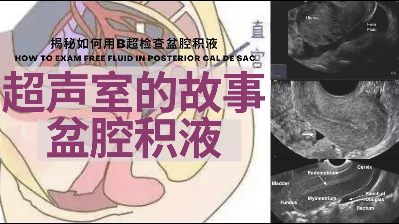 盆腔积液：B超报告上的&lsquo;盆腔积液&rsquo; 是什么/为什么有盆腔积液/不同类别/症状/B超是如何检查盆腔积液的/治疗方法【Ultrasound Room】Free Fluid in Cal de sac