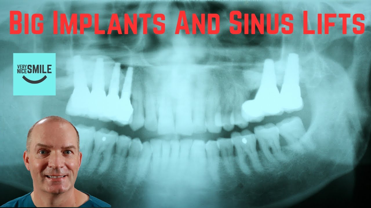 Big Implants and Sinus lifts