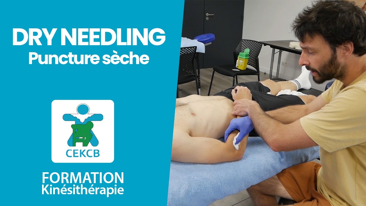 Dry needling – Puncture sèche