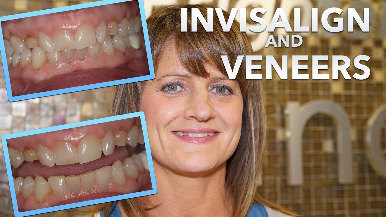 Do INVISALIGN first! MUST watch before getting DENTAL VENEERS!
