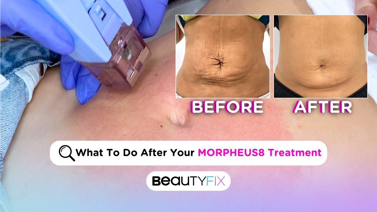 What to Do AFTER Morpheus8? | BeautyFix