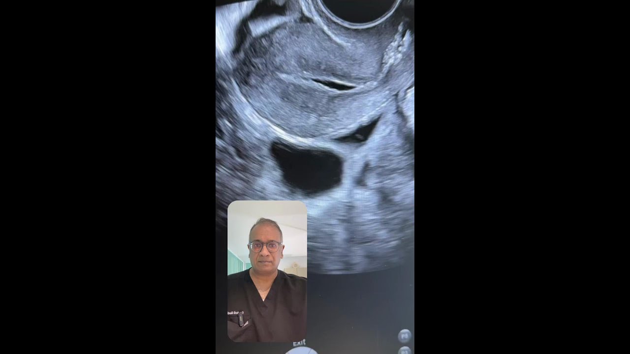 FLUID IN CAVITY